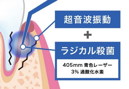 歯周病でお悩みの方へ【ブルーラジカル治療】を開始いたします｜2025年5月中旬〜