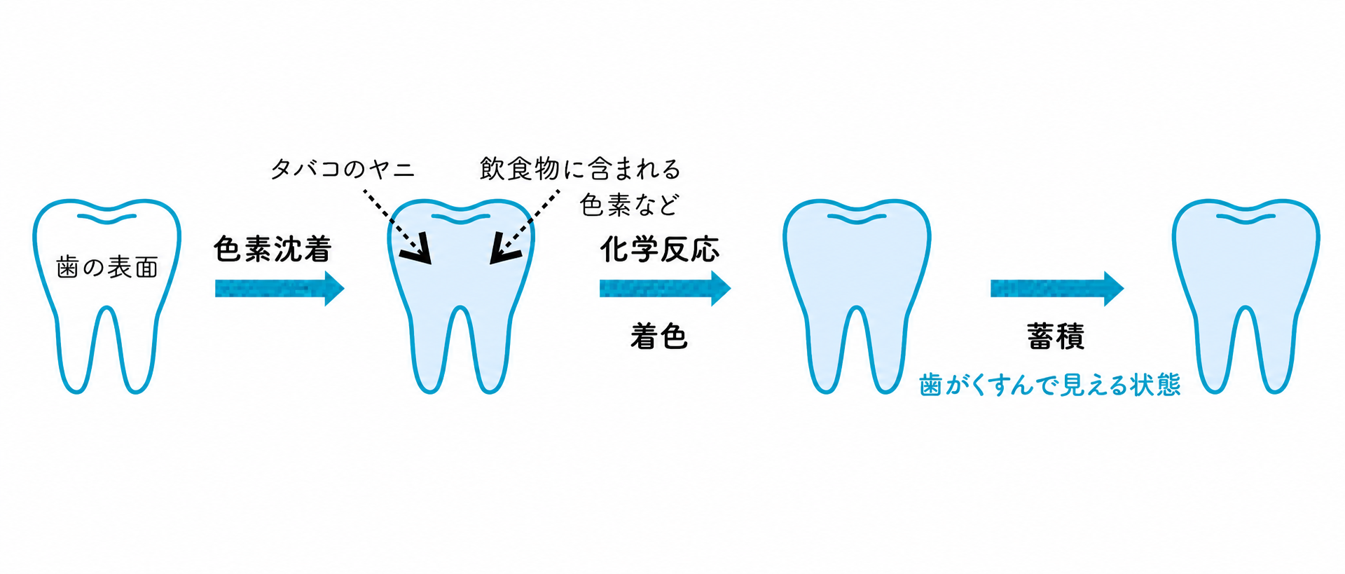その着色汚れ「エアフロー」で歯の輝きを取り戻しませんか？